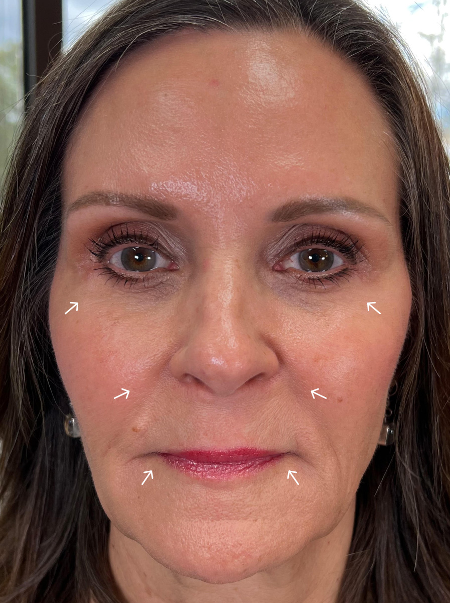 Nova-Concierge_Bio-Stimulator-Case-109-AP-After-Arrows