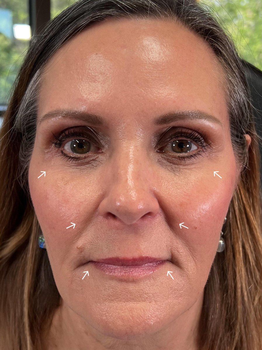 Nova-Concierge_Bio-Stimulator-Case-109-AP-Before-Arrows