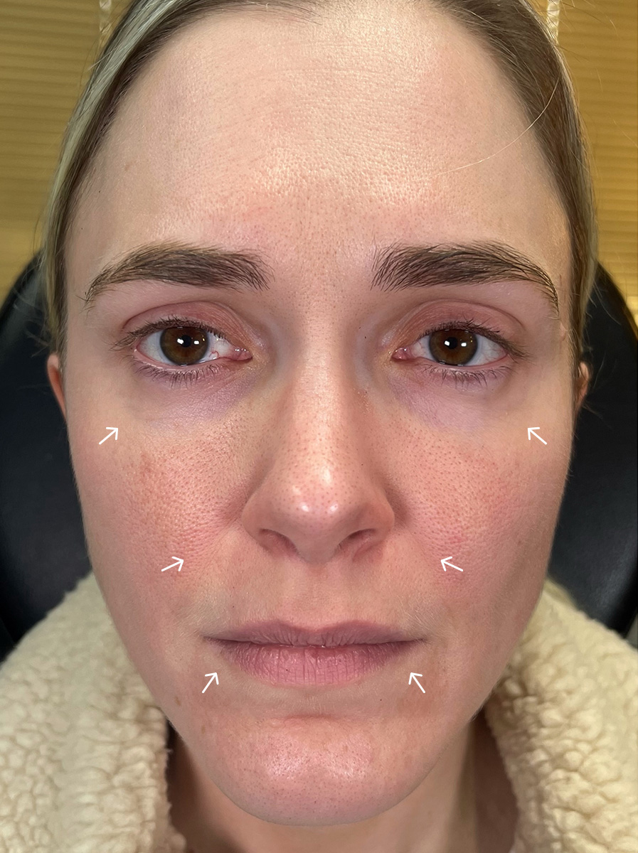 Nova-Concierge_Bio-Stimulator-Case-113-AP-After-Arrows