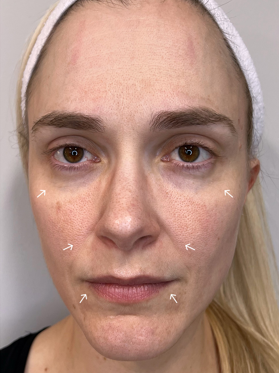 Nova-Concierge_Bio-Stimulator-Case-113-AP-Before-Arrows