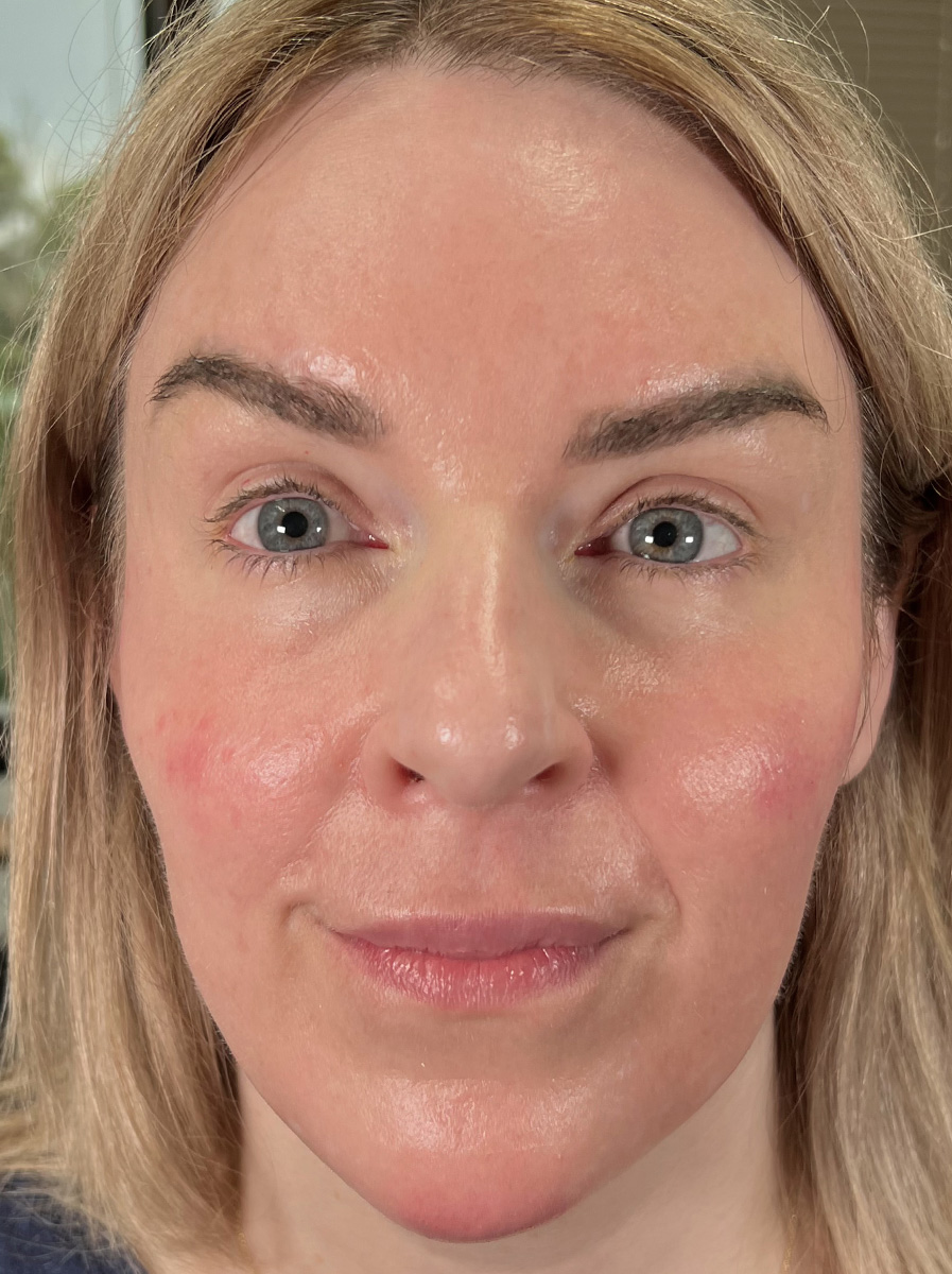 Nova-Concierge_Dermal-Fillers-Case-110-AP-After