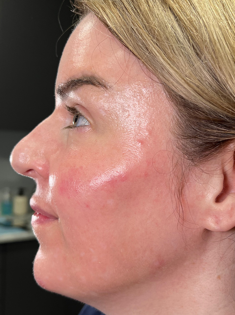 Nova-Concierge_Dermal-Fillers-Case-110-Left-LAT-After