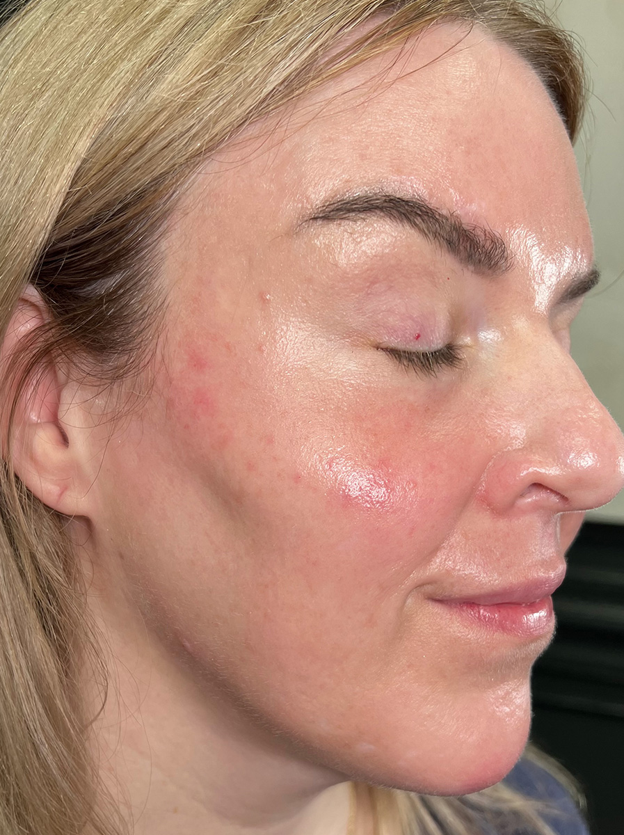 Nova-Concierge_Dermal-Fillers-Case-110-Right-OBL-After