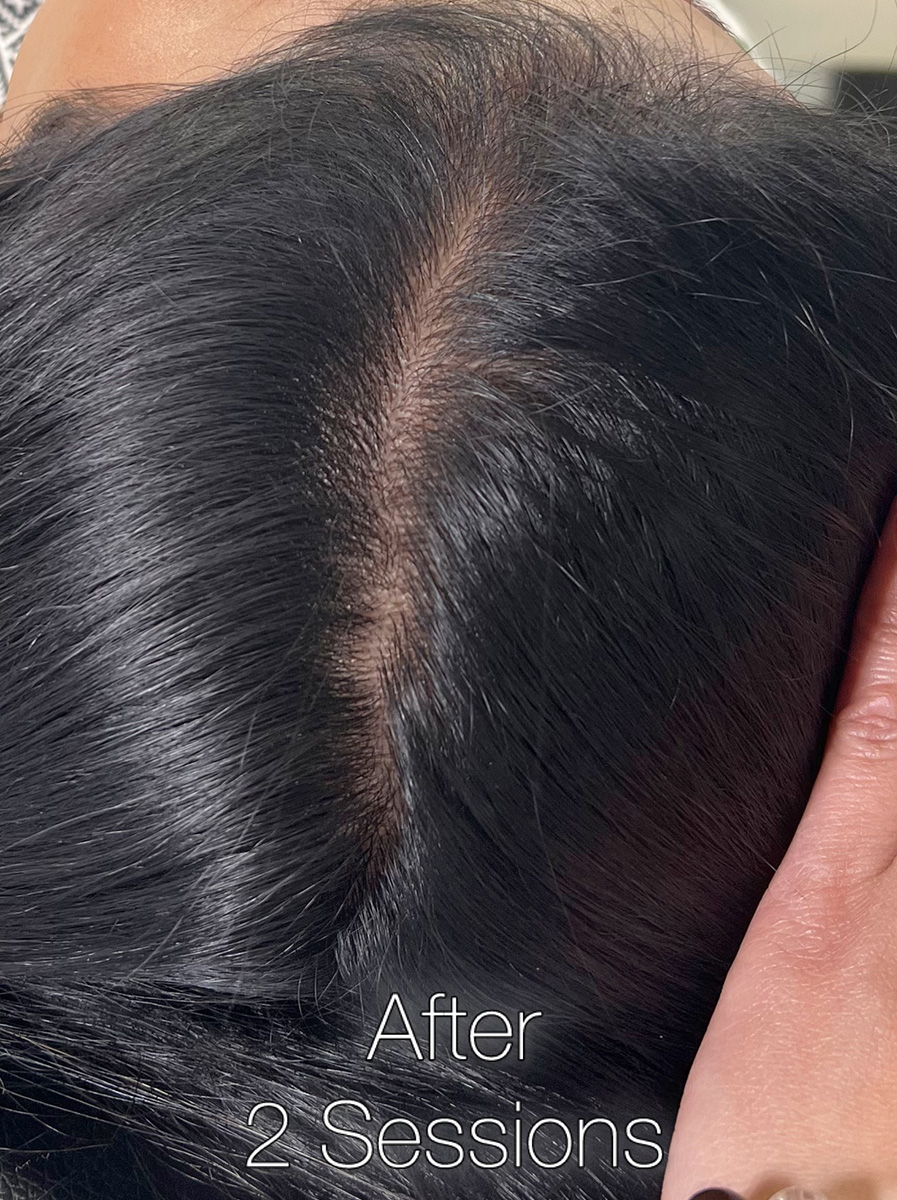 Nova-Concierge_Hair-Exosomes-Case-107-TOP-After-2