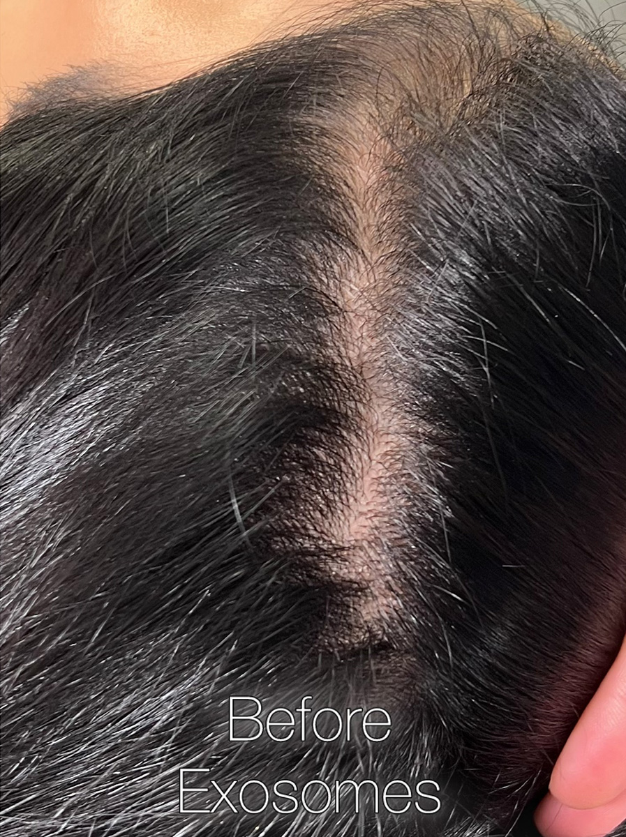 Nova-Concierge_Hair-Exosomes-Case-107-TOP-Before-2