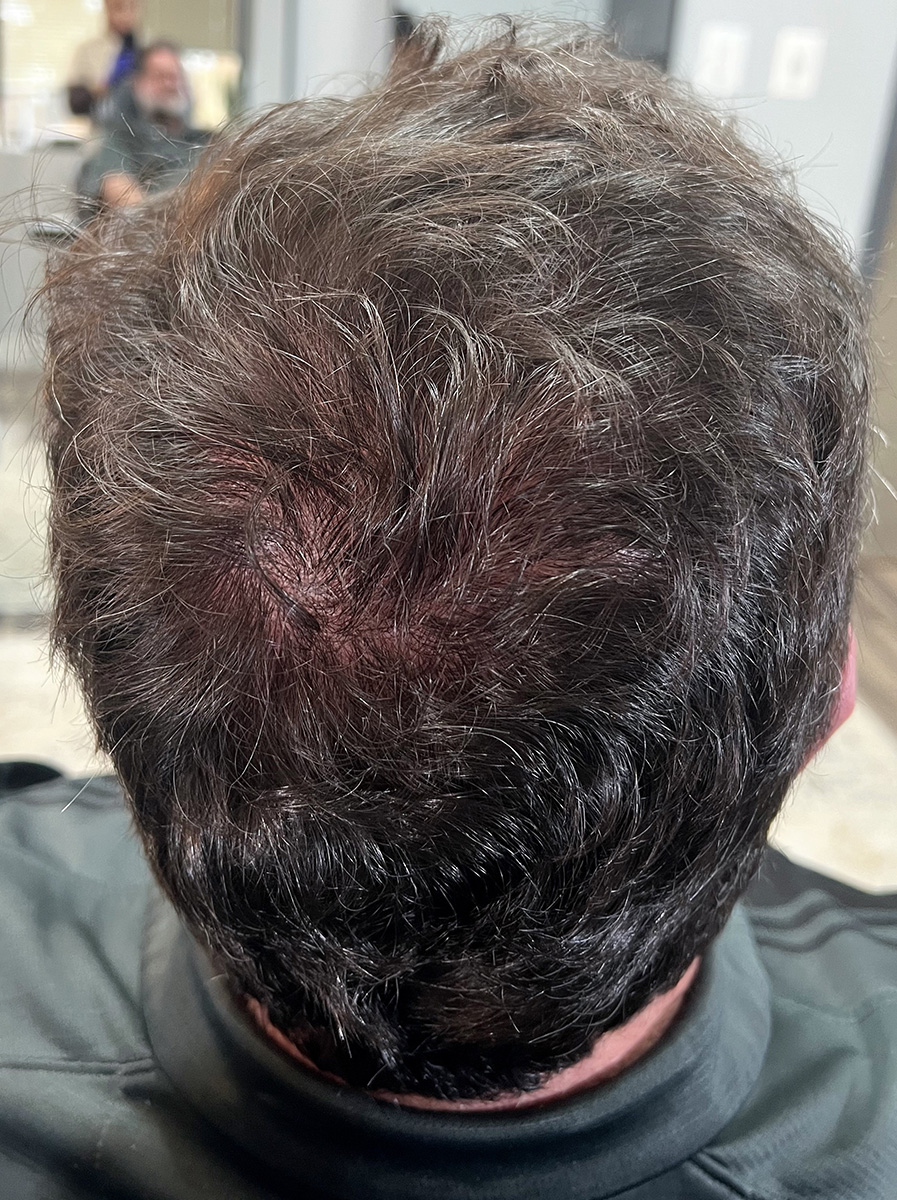 Nova-Concierge_Hair-Exosomes-Case-108-POS-After