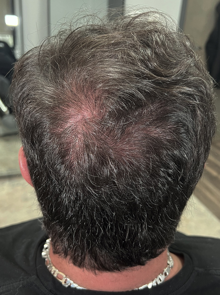 Nova-Concierge_Hair-Exosomes-Case-108-POS-Before