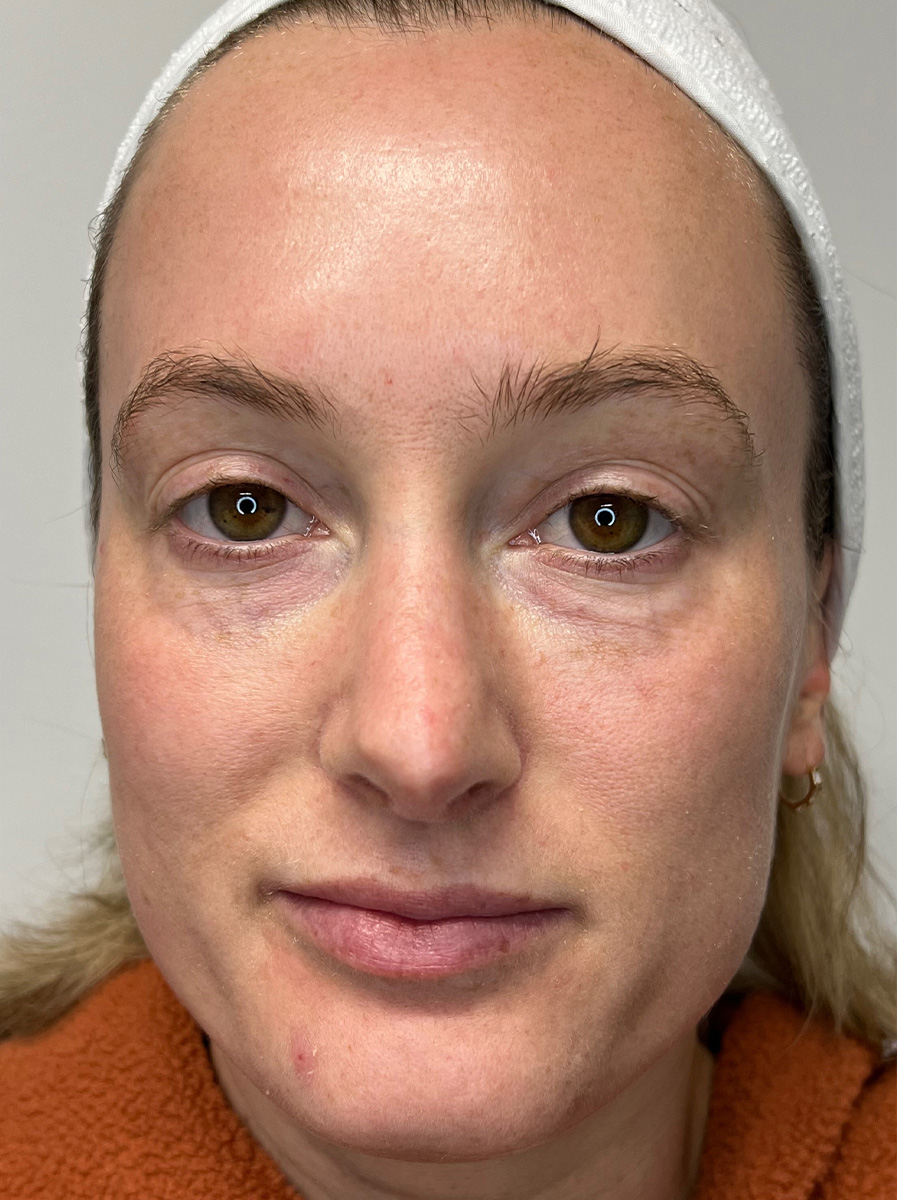 Nova-Concierge_Halo-BBL-MOXI-Case-1-AP-After