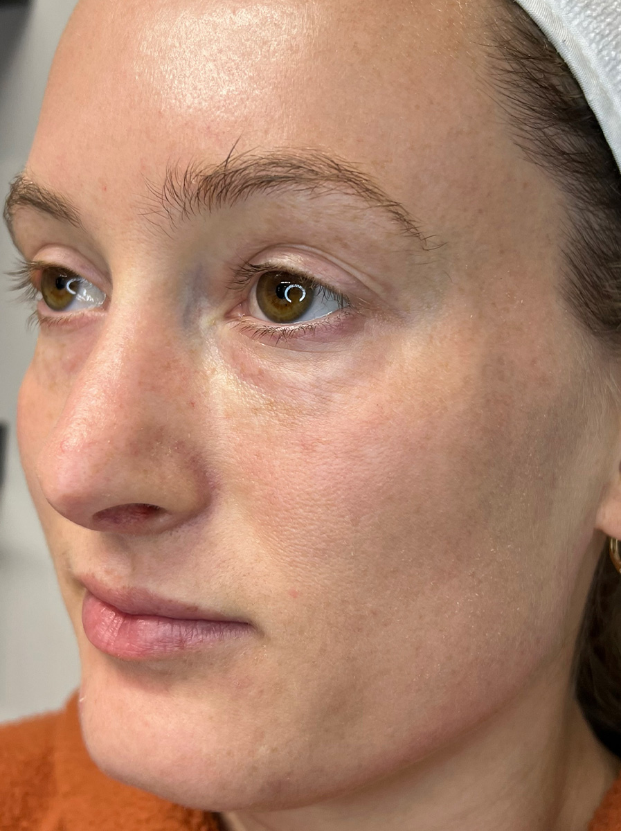 Nova-Concierge_Halo-BBL-MOXI-Case-1-Left-OBL-After