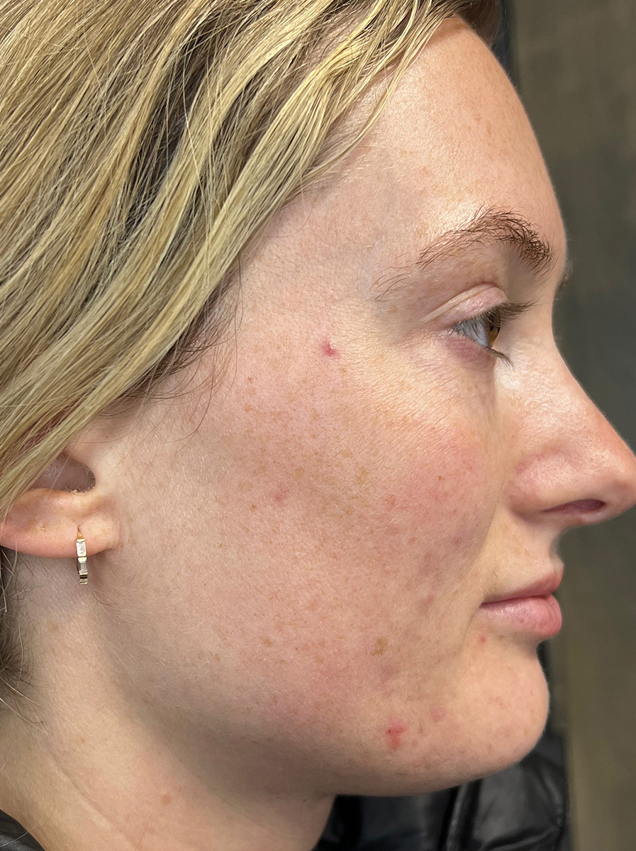 Nova-Concierge_Halo-BBL-MOXI-Case-1-Right-LAT-Before