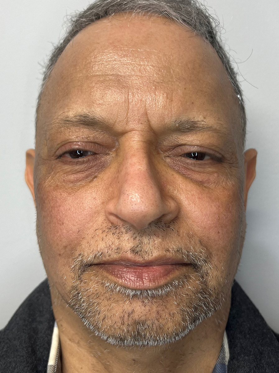 Nova-Concierge_Halo-MOXI-Case-103-AP-After