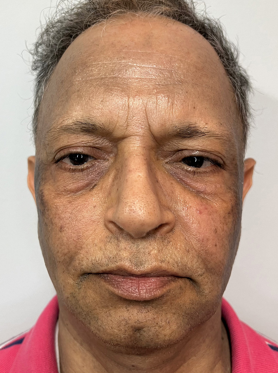 Nova-Concierge_Halo-MOXI-Case-103-AP-Before