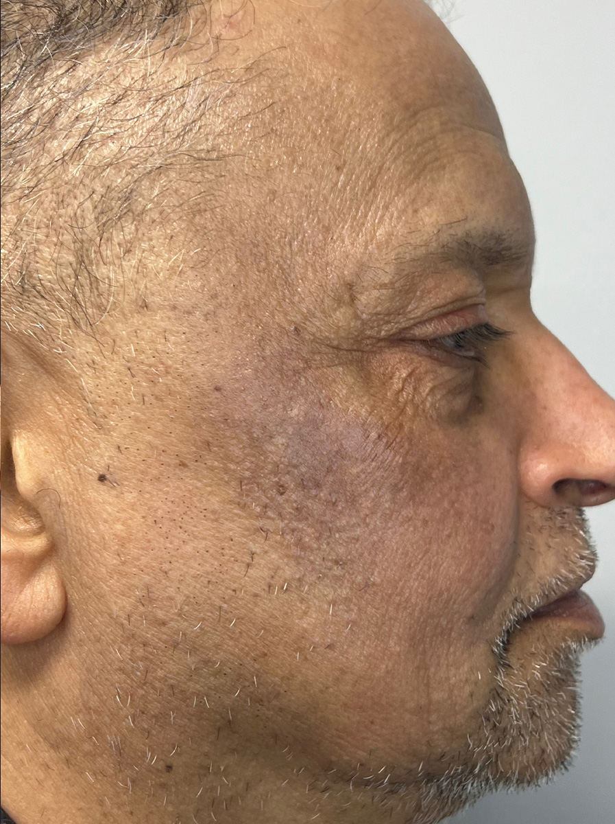 Nova-Concierge_Halo-MOXI-Case-103-Right-LAT-After