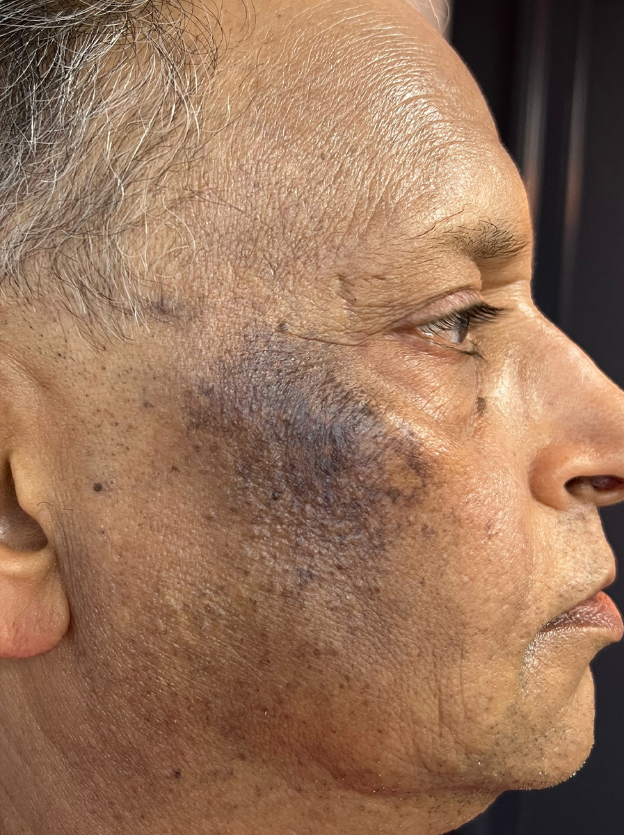 Nova-Concierge_Halo-MOXI-Case-103-Right-LAT-Before