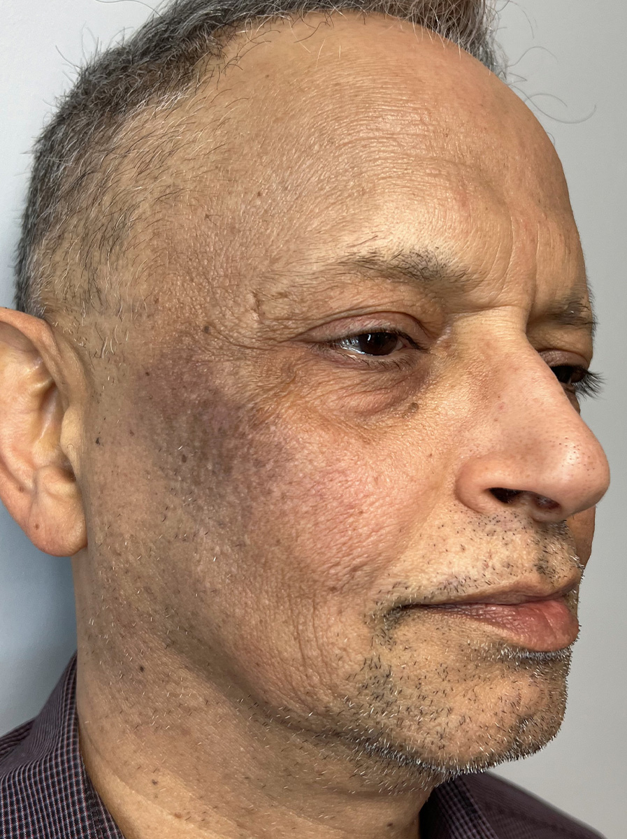 Nova-Concierge_Halo-MOXI-Case-103-Right-OBL-After