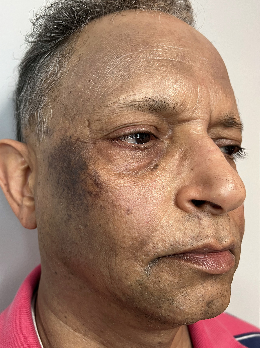 Nova-Concierge_Halo-MOXI-Case-103-Right-OBL-Before