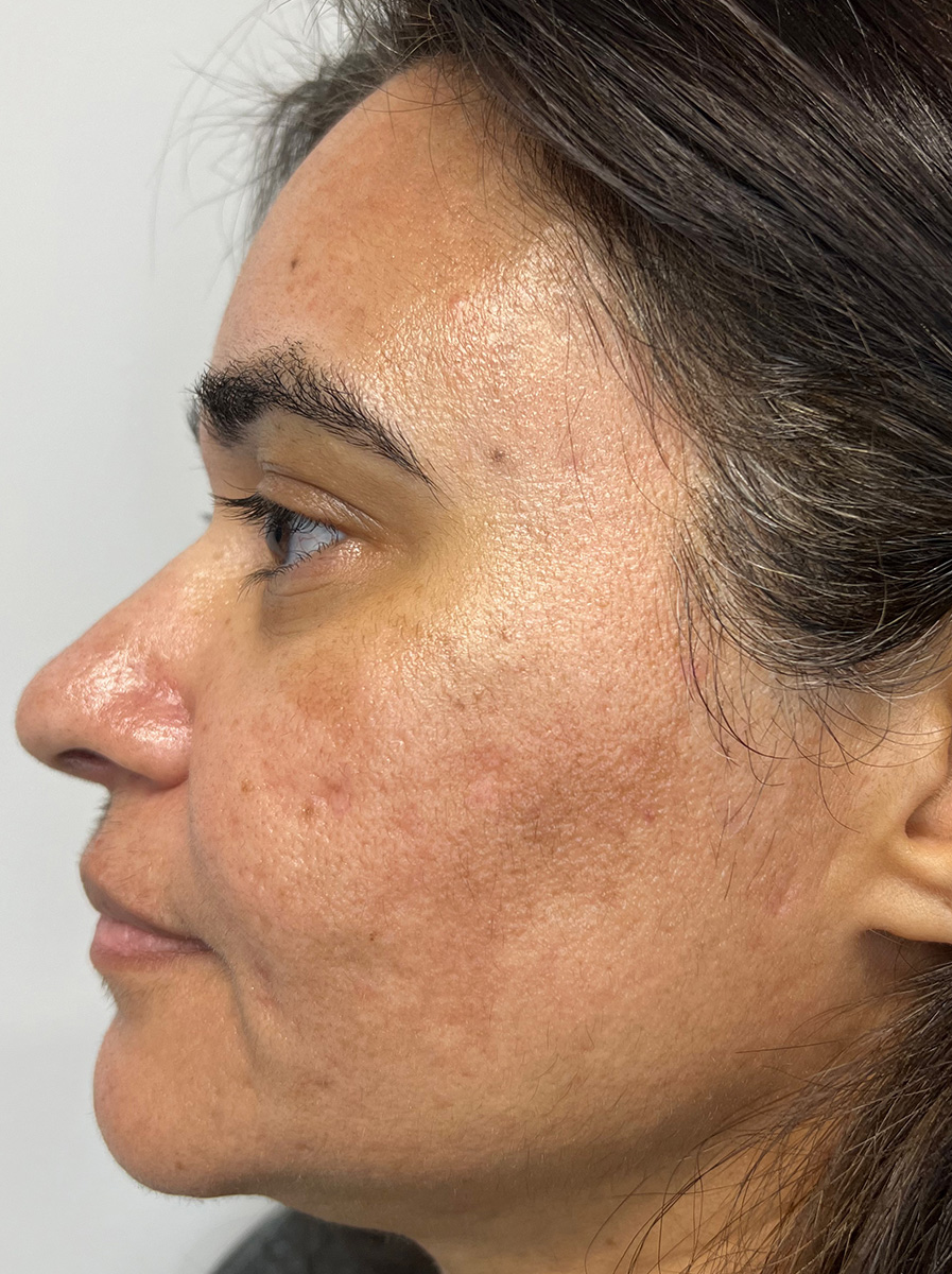 Nova-Concierge_MOXI-Case-102-Left-LAT-After