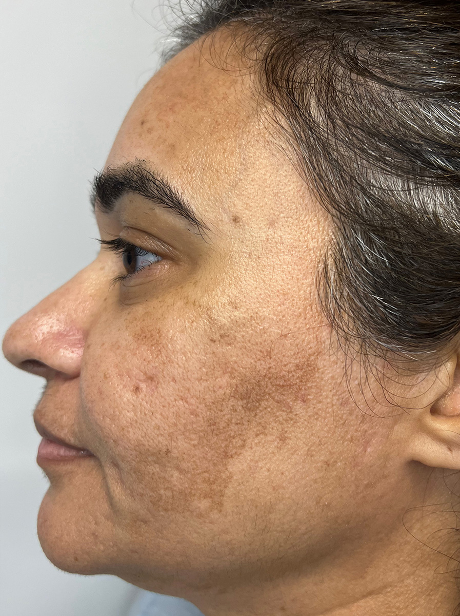 Nova-Concierge_MOXI-Case-102-Left-LAT-Before