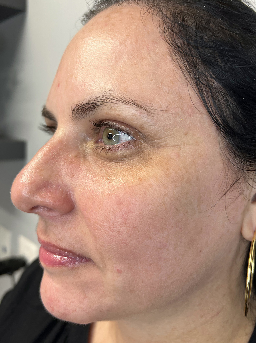 Nova-Concierge_MOXI-Case-104-Left-OBL-After