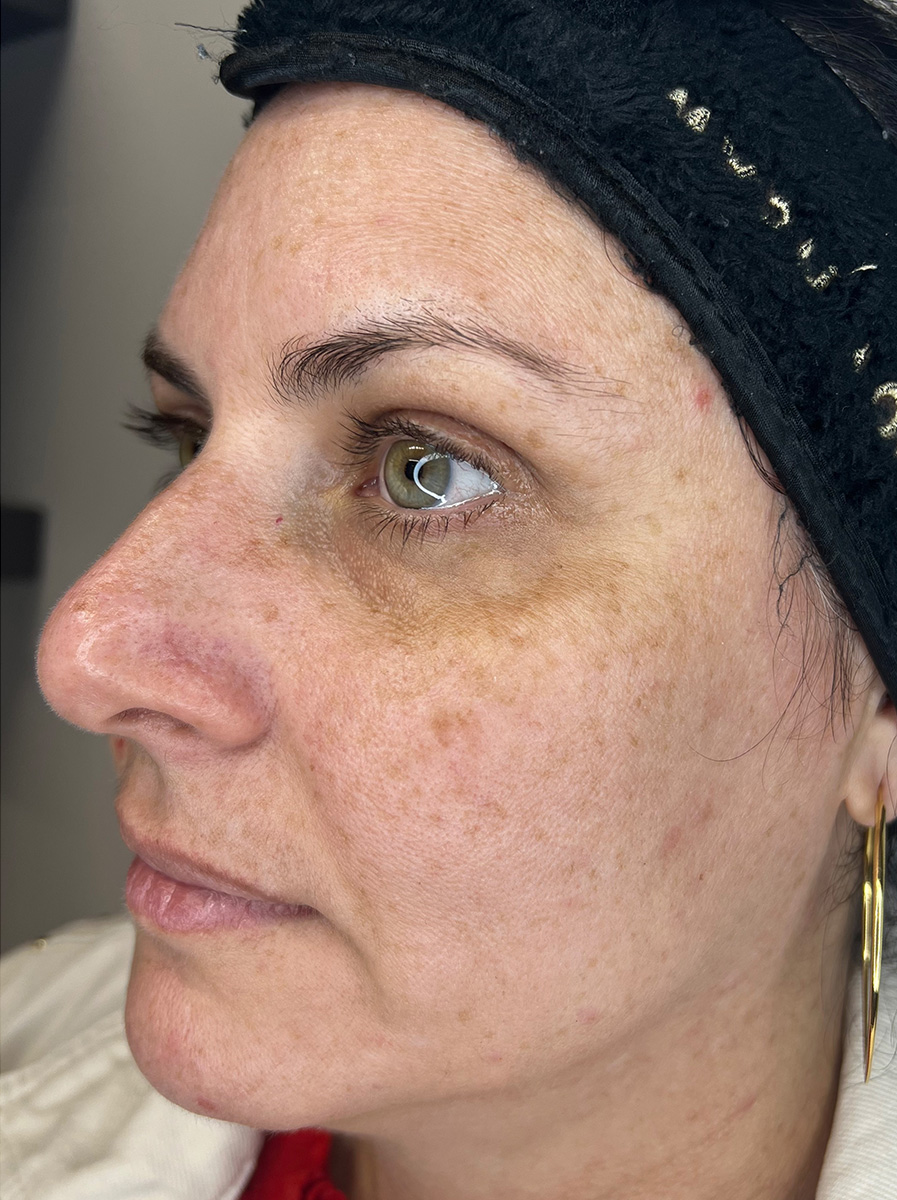 Nova-Concierge_MOXI-Case-104-Left-OBL-Before