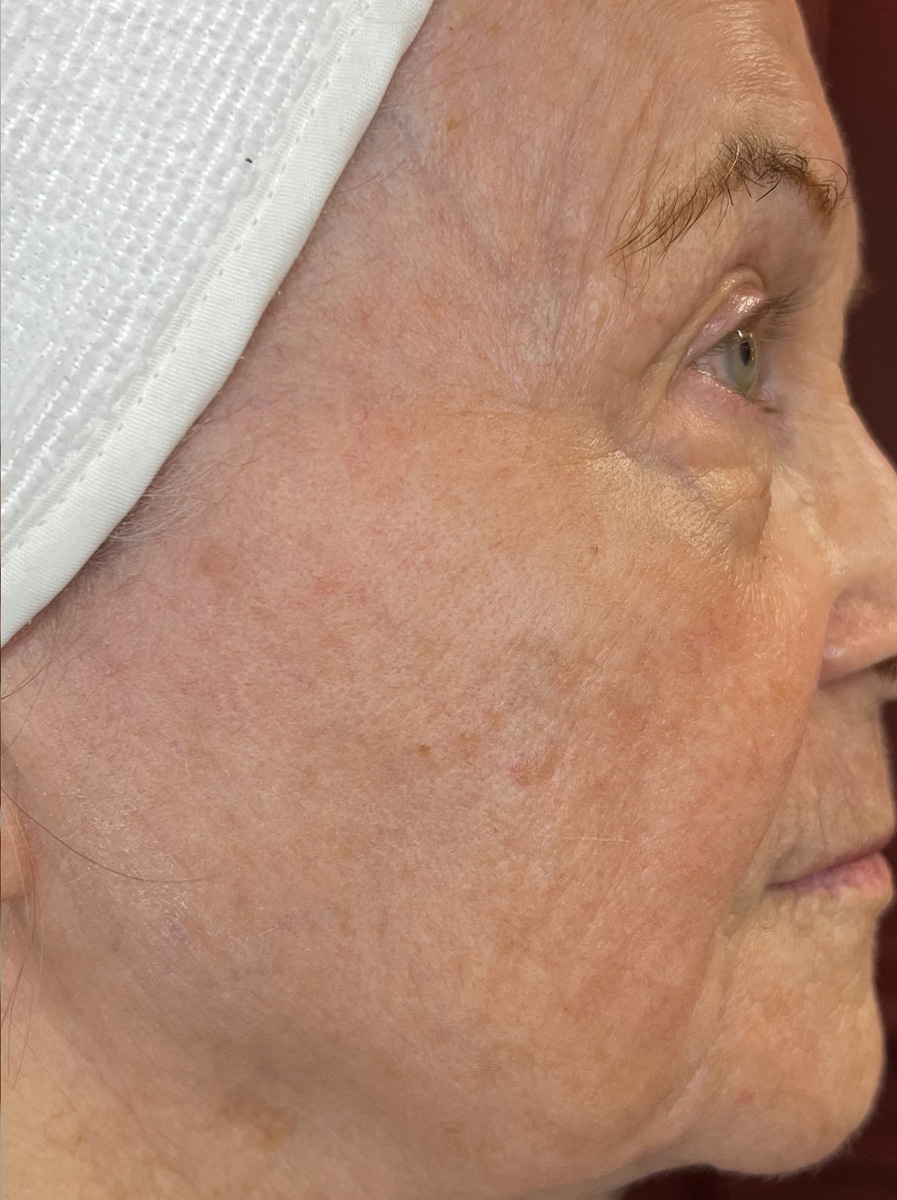 Nova-Concierge_MOXI-Case-105-Right-LAT-After