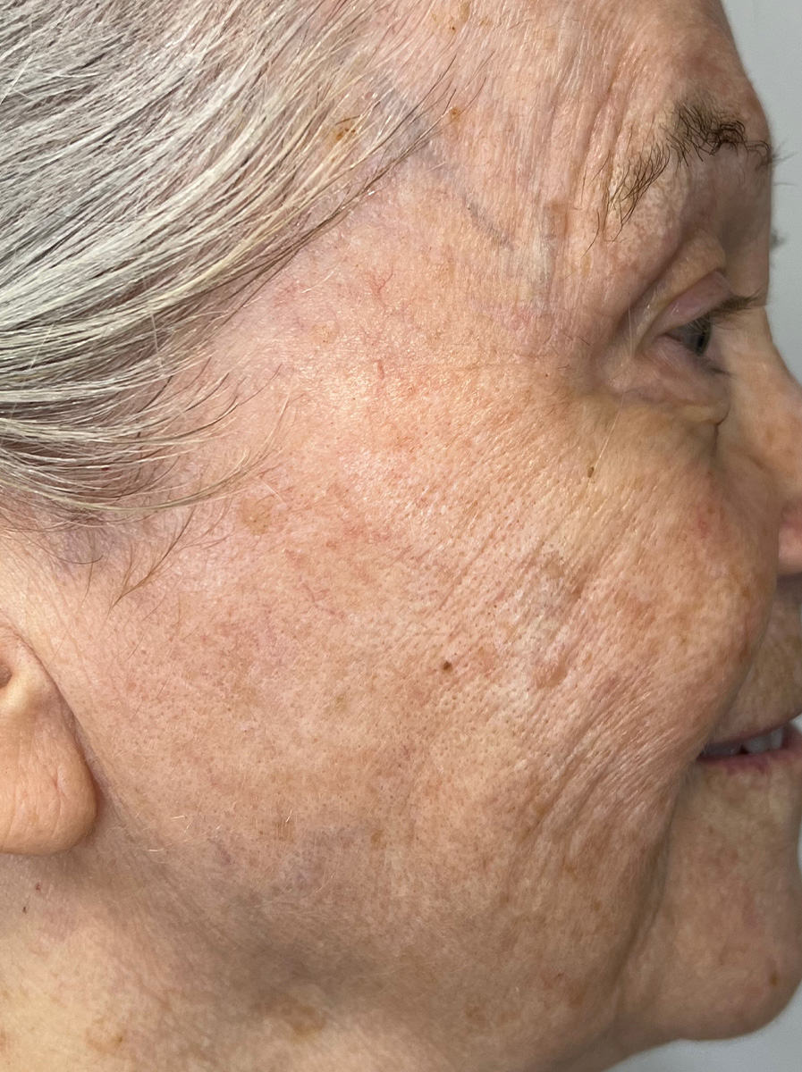 Nova-Concierge_MOXI-Case-105-Right-LAT-Before