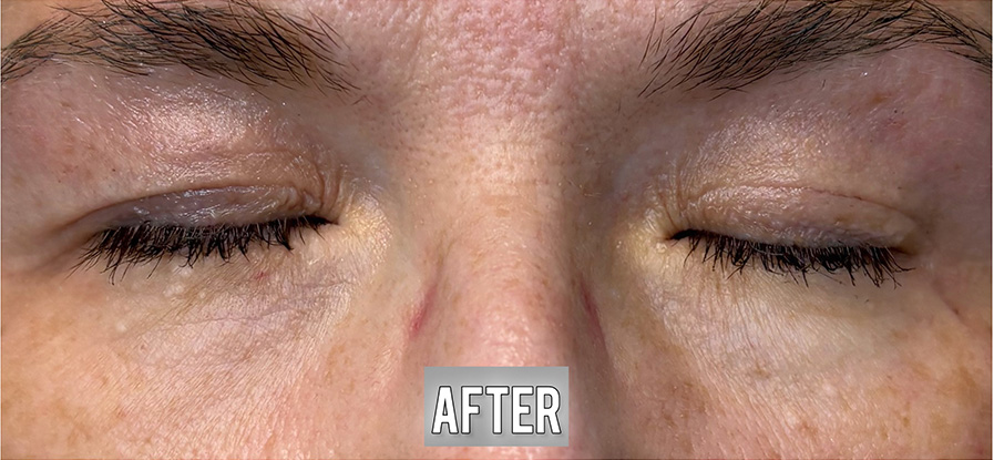 Nova-Concierge_Plasma-iQ-Case-111-AP-After