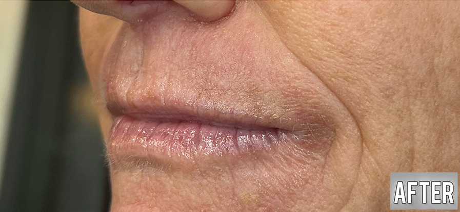 Nova-Concierge_Plasma-iQ-Case-112-Left-OBL-After