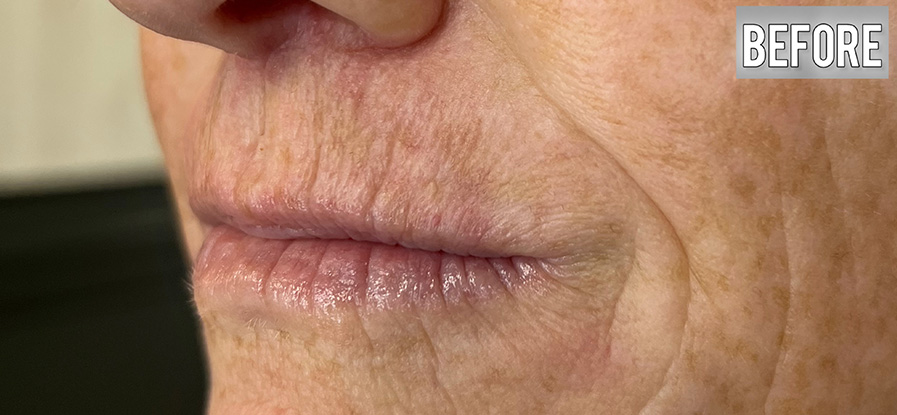 Nova-Concierge_Plasma-iQ-Case-112-Left-OBL-Before