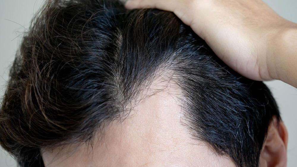 Exosome Hair Restoration in Fairfax, VA